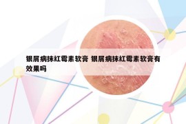 银屑病抹红霉素软膏 银屑病抹红霉素软膏有效果吗