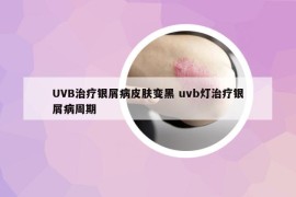 UVB治疗银屑病皮肤变黑 uvb灯治疗银屑病周期