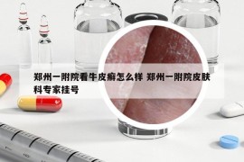 郑州一附院看牛皮癣怎么样 郑州一附院皮肤科专家挂号