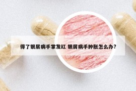 得了银屑病手掌发红 银屑病手肿胀怎么办?