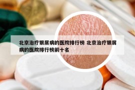 北京治疗银屑病的医院排行榜 北京治疗银屑病的医院排行榜前十名