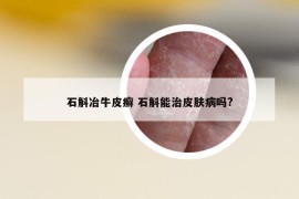 石斛冶牛皮癣 石斛能治皮肤病吗?