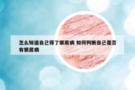 怎么知道自己得了银屑病 如何判断自己是否有银屑病