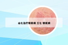 山七治疗银屑病 三七 银屑病