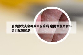 扁桃体发炎会导致牛皮癣吗 扁桃体发炎会不会引起银屑病