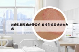 丘疹性银屑病会传染吗 丘疹型银屑病能治愈吗