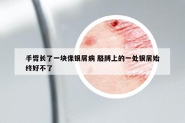 手臂长了一块像银屑病 胳膊上的一处银屑始终好不了