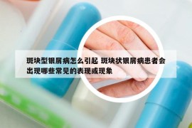 斑块型银屑病怎么引起 斑块状银屑病患者会出现哪些常见的表现或现象