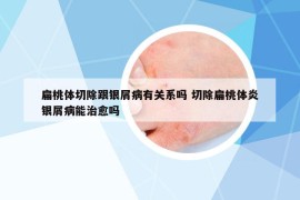 扁桃体切除跟银屑病有关系吗 切除扁桃体炎银屑病能治愈吗