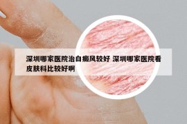 深圳哪家医院治白癜风较好 深圳哪家医院看皮肤科比较好啊