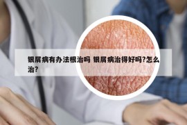 银屑病有办法根治吗 银屑病治得好吗?怎么治?