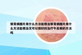 银霄病图片用什么方法能根治银霄病图片用什么方法能根治又可以很好的治疗牛皮癣的方法吗