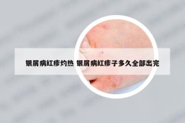 银屑病红疹灼热 银屑病红疹子多久全部出完