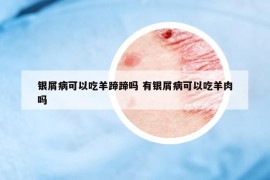 银屑病可以吃羊蹄蹄吗 有银屑病可以吃羊肉吗