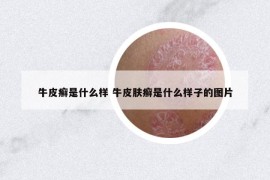 牛皮癣是什么样 牛皮肤癣是什么样子的图片