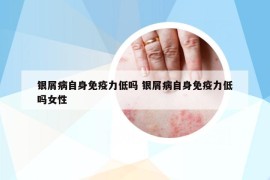 银屑病自身免疫力低吗 银屑病自身免疫力低吗女性