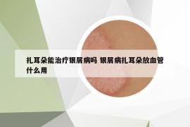 扎耳朵能治疗银屑病吗 银屑病扎耳朵放血管什么用