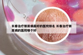 长春治疗银屑病最好的医院排名 长春治疗银屑病的医院哪个好