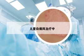 儿童白癜风治疗中