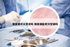 银屑病可以受凉吗 银屑病能吹冷空调吗