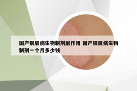 国产银屑病生物制剂副作用 国产银屑病生物制剂一个月多少钱