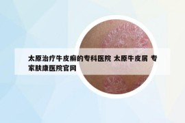 太原治疗牛皮癣的专科医院 太原牛皮屑 专家肤康医院官网