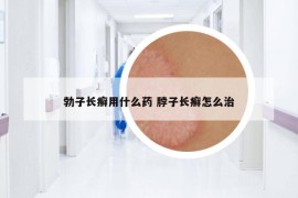 勃子长癣用什么药 脖子长癣怎么治