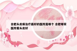 合肥头皮癣治疗最好的医院是哪个 合肥哪家医院看头皮好