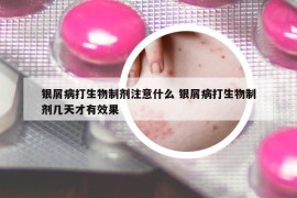 银屑病打生物制剂注意什么 银屑病打生物制剂几天才有效果