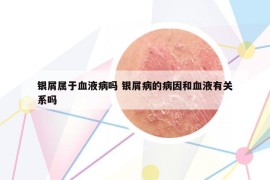 银屑属于血液病吗 银屑病的病因和血液有关系吗