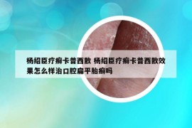 杨绍臣疗癣卡普西散 杨绍臣疗癣卡普西散效果怎么样治口腔扁平胎癣吗