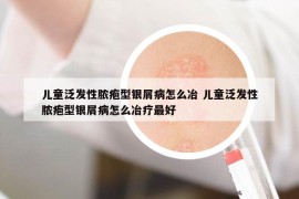 儿童泛发性脓疱型银屑病怎么冶 儿童泛发性脓疱型银屑病怎么冶疗最好