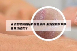 点滴型银屑病起白皮特别痒 点滴型银屑病颜色变浅起皮了