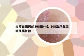 治疗白癜风的308是什么 308治疗白斑癜风易扩散