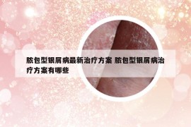 脓包型银屑病最新治疗方案 脓包型银屑病治疗方案有哪些