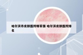 哈尔滨市皮肤医院哪家强 哈尔滨皮肤医院排名