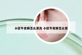 小区牛皮癣怎么清洗 小区牛皮鲜怎么管