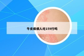 牛皮癣病人吃159行吗