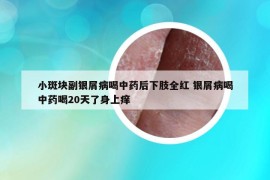 小斑块副银屑病喝中药后下肢全红 银屑病喝中药喝20天了身上痒