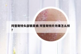 阿普斯特头部银屑病 阿普斯特片效果怎么样?