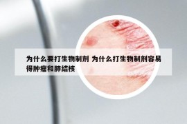 为什么要打生物制剂 为什么打生物制剂容易得肿瘤和肺结核