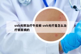 uvb光照治疗牛皮癣 uvb光疗是怎么治疗银屑病的