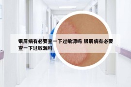 银屑病有必要查一下过敏源吗 银屑病有必要查一下过敏源吗