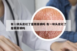 有一块头皮红了是银屑病吗 有一块头皮红了是银屑病吗