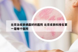 北京治皮肤病最好的医院 北京皮肤科排名第一是哪个医院