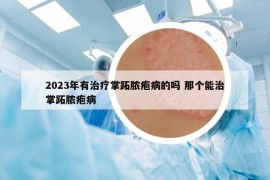 2023年有治疗掌跖脓疱病的吗 那个能治掌跖脓疱病