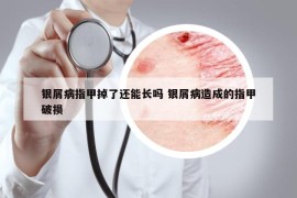 银屑病指甲掉了还能长吗 银屑病造成的指甲破损