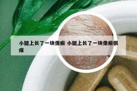 小腿上长了一块像癣 小腿上长了一块像癣很痒