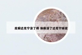 皮癣达克宁涂了疼 体癣涂了达克宁掉皮