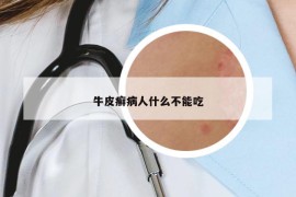 牛皮癣病人什么不能吃